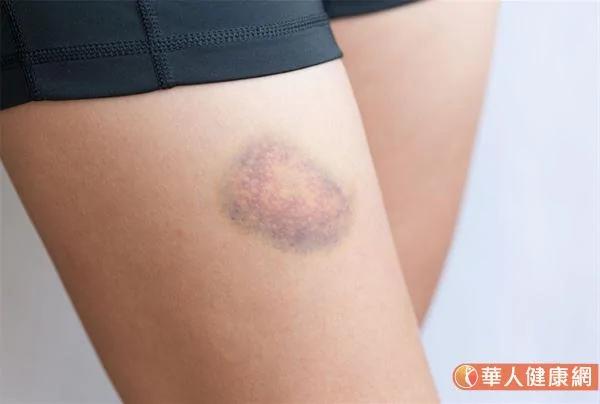 拍打功打到瘀青、岀痧才有效？中醫師來解答 14類人不建議胡亂嘗試