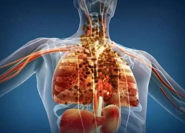 為什麼肺癌越來越多？忠告：少惹三種「氣」 頭部3個表現要就醫