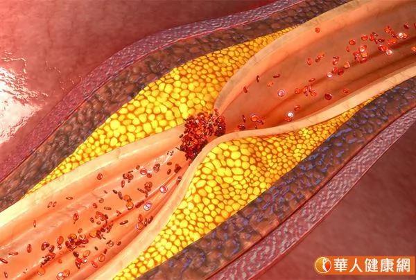 绿花椰菜不只抗癌 还防血管钙化!并能降低腹主动脉钙化风险