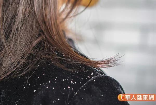 头皮搔痒、脱屑 脂漏性皮肤炎补维生素B6有帮助?专家教授治疗全攻略