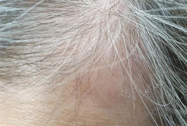 头皮搔痒、脱屑 脂漏性皮肤炎补维生素B6有帮助?专家教授治疗全攻略