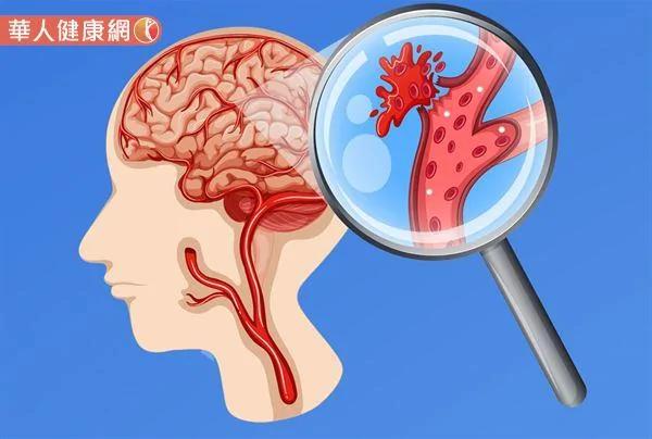 睡觉咬到舌头、嘴巴是脑中风前兆?医师来解答 防中风上门40岁后必做这件事