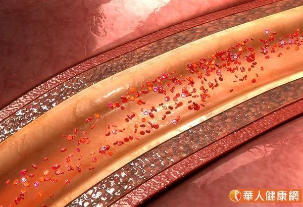 钙片吃太多 会让血管钙化老叩叩?中医:吃绿丹参粥祛瘀血 保护心血管