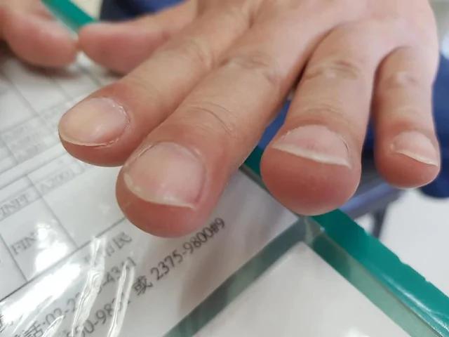 手指末端变粗大 暗示肺癌、心脏病!还有2种变化都是危险警讯