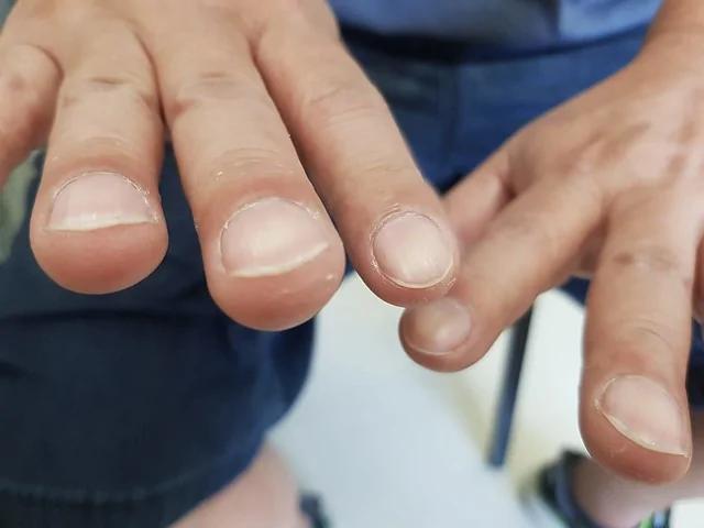 手指末端变粗大 暗示肺癌、心脏病!还有2种变化都是危险警讯