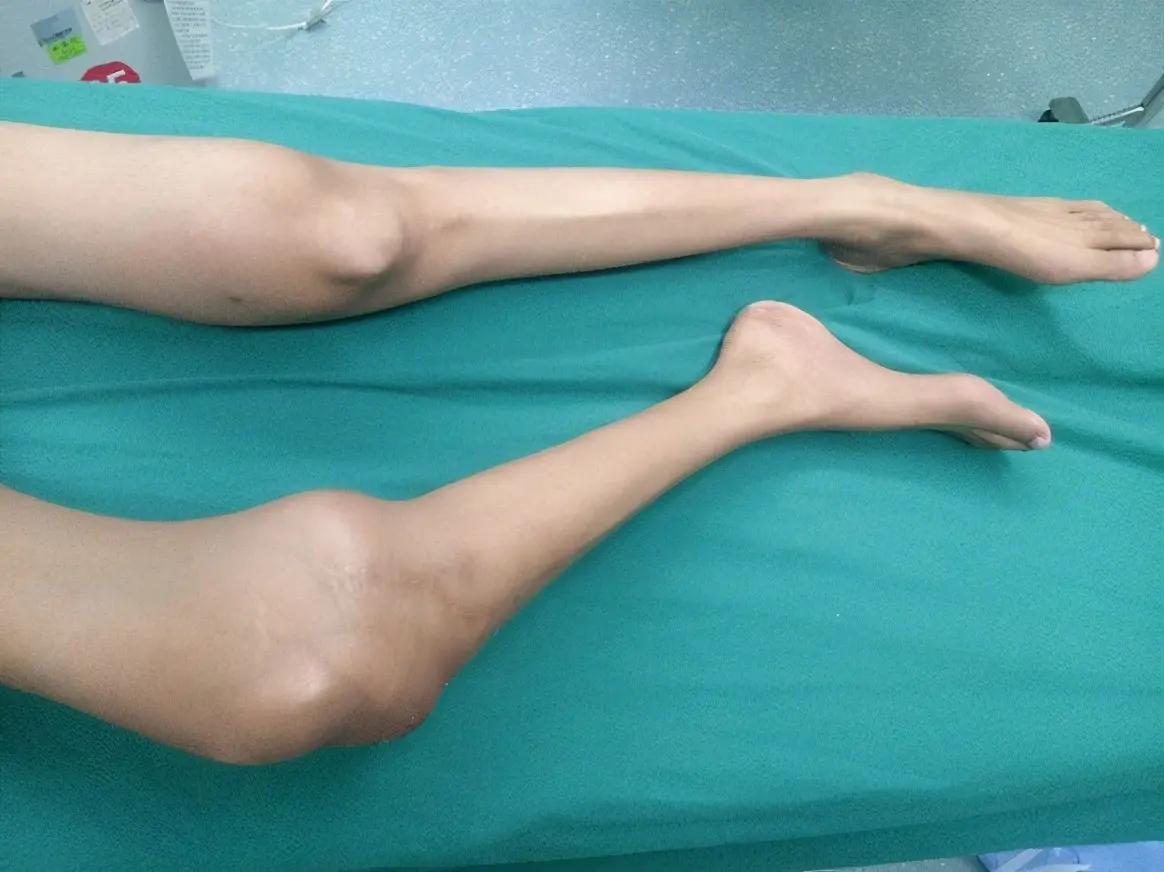 孩子被查出骨肉瘤晚期 家长懊悔:错把骨痛当生长痛