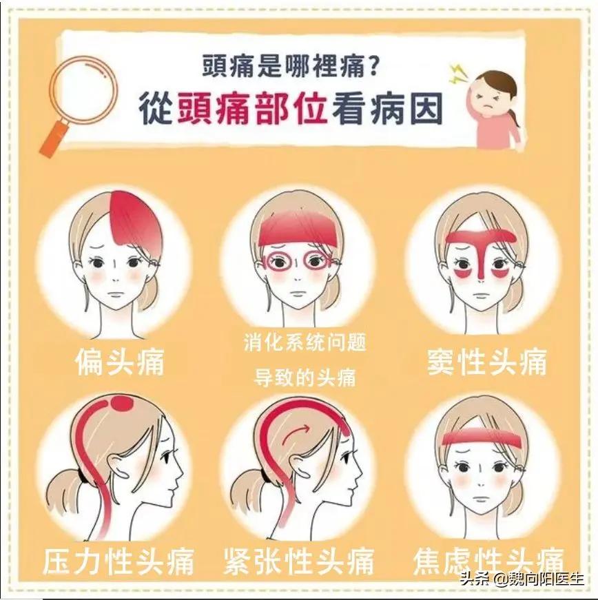 头痛的真相:头痛并不是大脑痛 颅周组织引起头痛