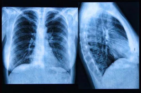 中國第一大癌 80%發現都已經是晚期！提醒：3個肺癌前兆 一定要牢記