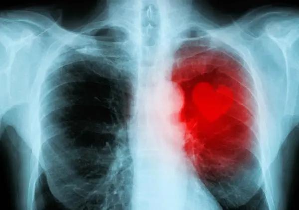 中國第一大癌 80%發現都已經是晚期！提醒：3個肺癌前兆 一定要牢記