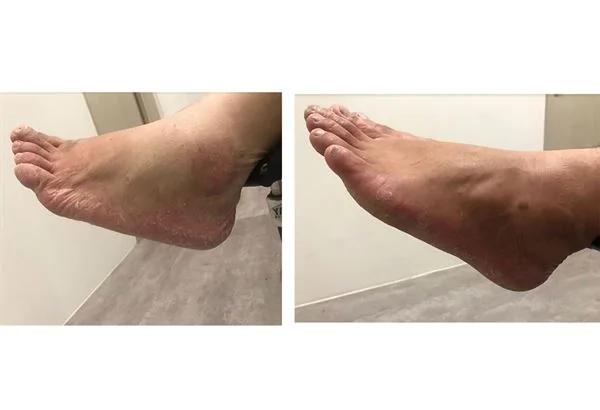 脚是第二心脏!鞋袜不合经常摩擦 小心这些脚病跟着来!