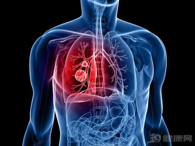 新研究：肺癌「弱點」被找到！不想得肺癌 快避開這4點