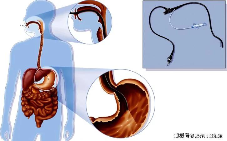 胃癌的「禍根」，不只是菸酒，有5種行為的人，最好去查查胃