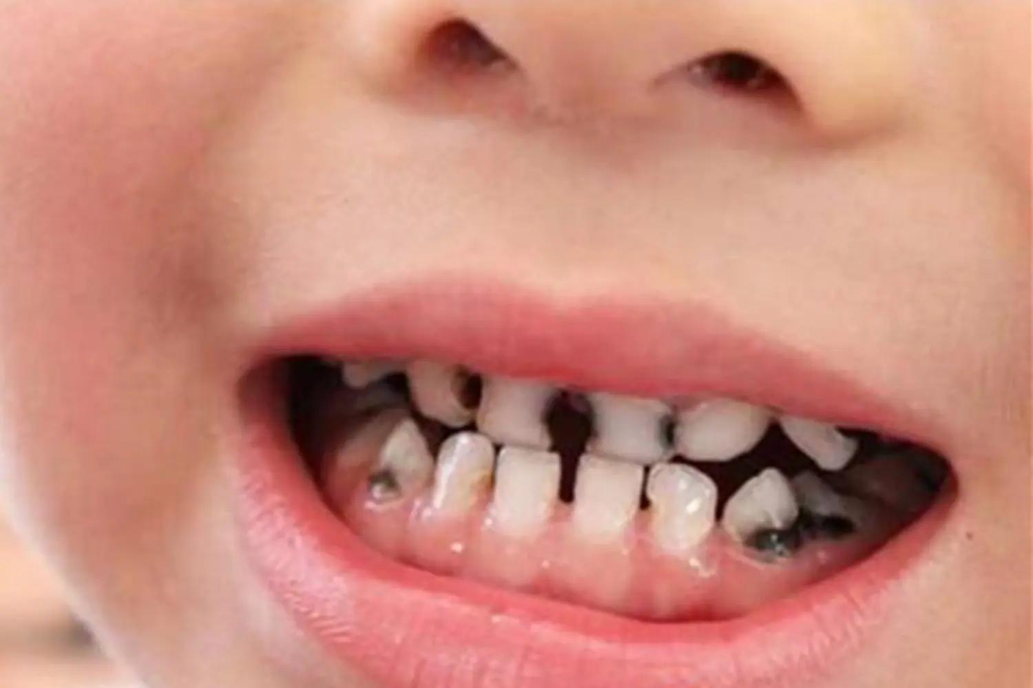 3歲寶寶從不吃糖，卻還是滿口蛀牙，牙醫指出的問題值得重視