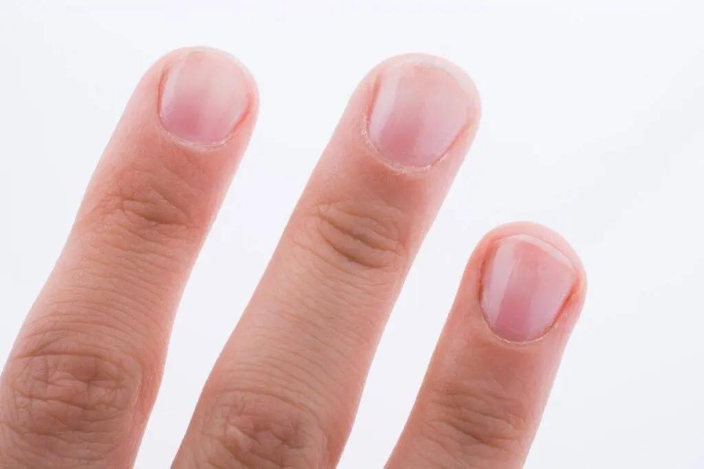 警惕！四種指甲特徵可能是糖尿病的先兆