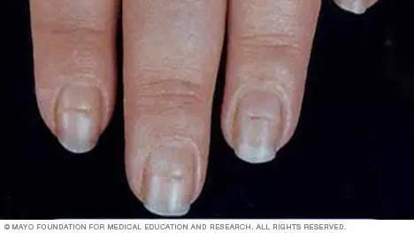 警惕！四種指甲特徵可能是糖尿病的先兆