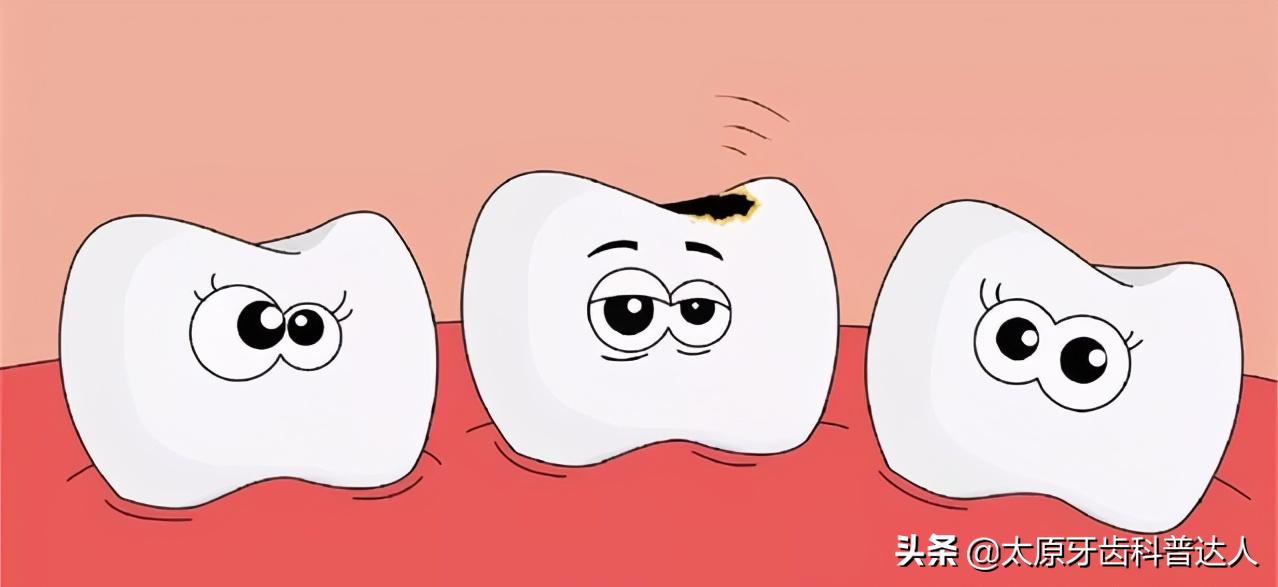 明明沒牙疼，為啥醫生說我牙壞了？蛀牙各階段症狀大解析