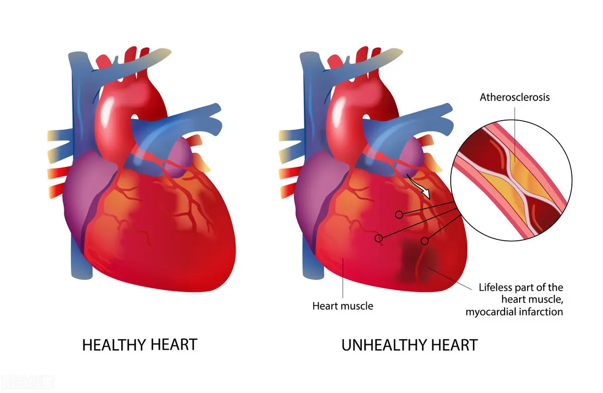 心血管堵没堵？走一走就知道！如果胸痛有这4个特征，一定要注意