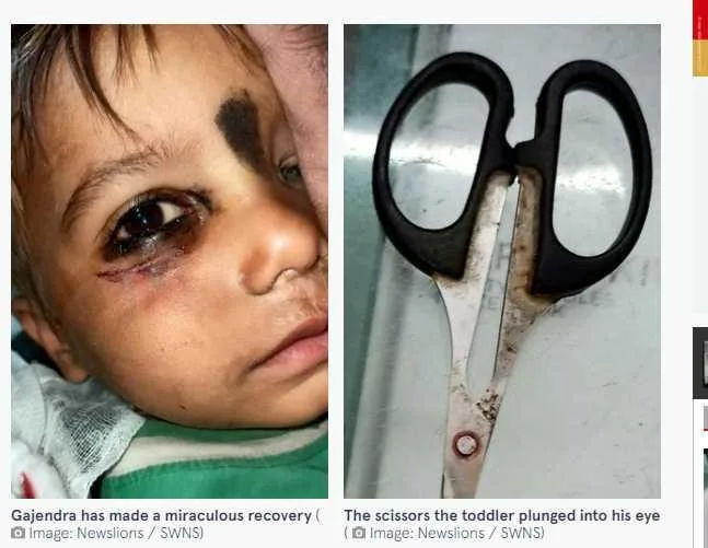 一名3岁男童将剪刀插进自己眼睛里，差点失明。（图／翻摄自镜报）