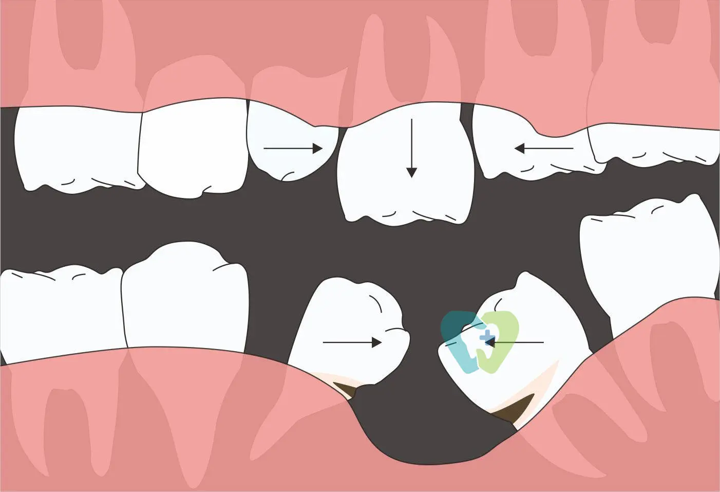 缺牙不补的十大危害你知道吗，比你想象的严重得多