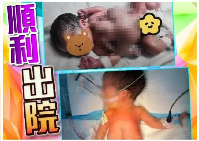 深圳现4手4脚婴儿 属全球罕见寄生胎