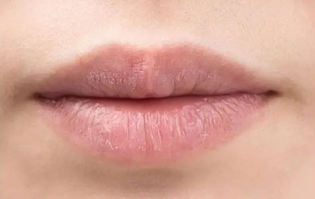 嘴唇總是乾燥起皮，並不是缺水，醫生：或與1個器官有關