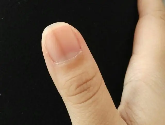 为什么指甲上有竖纹？指甲若出现4种异常，或是这几种问题的信号