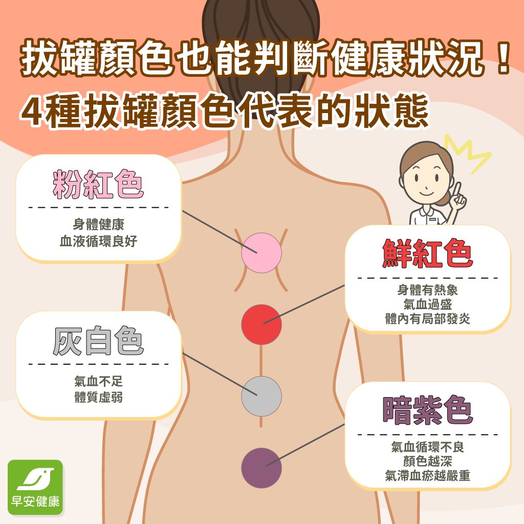 拔罐颜色代表什么？拔罐禁忌、原理与功效总整理