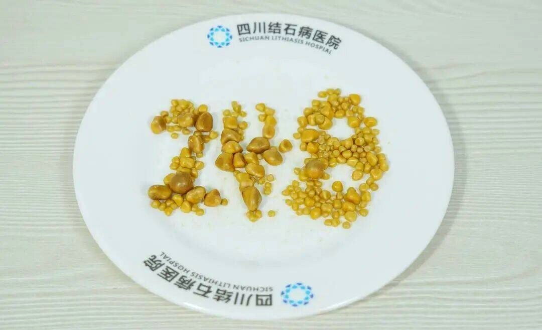 从江先生胆囊内取出的结石。(取材自环球网)